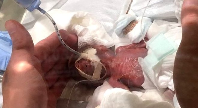 Em prematuros, o homem é o ''sexo frágil''