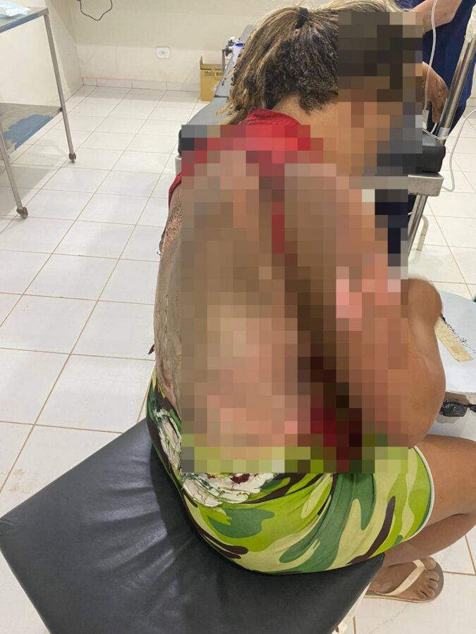 Homem joga gasolina em cama e mulher tem parte do corpo queimado no Sul do Piauí