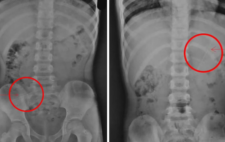 Menino de 7 anos engole lápis inteiro de 10 cm; veja fotos