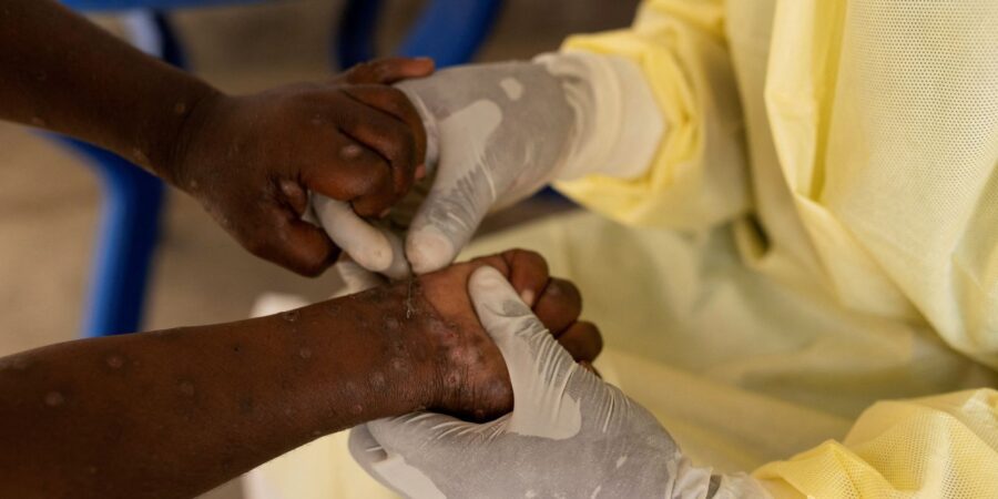 OMS declara mpox como emergência em saúde pública global