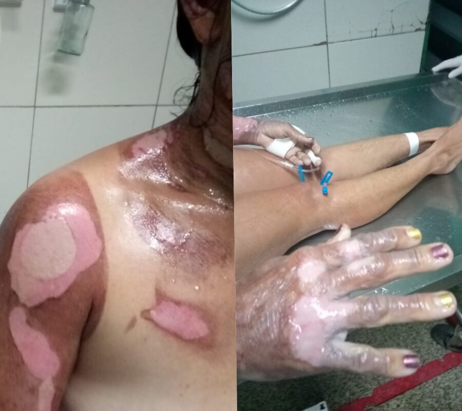 Vendedora sofre queimaduras graves após acidente com botijão de gás