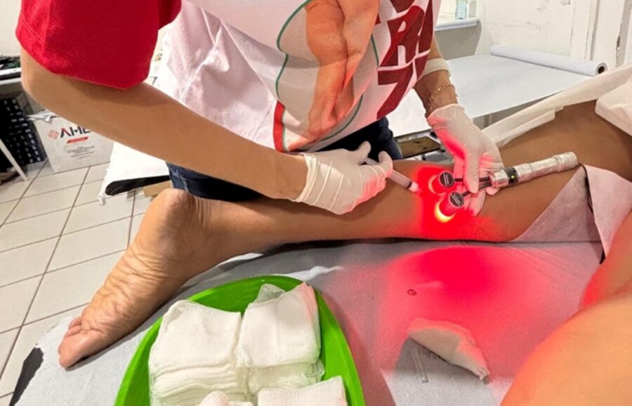 Programa de tratamento de varizes da Sesapi divulga cronograma de consultas; veja os municípios