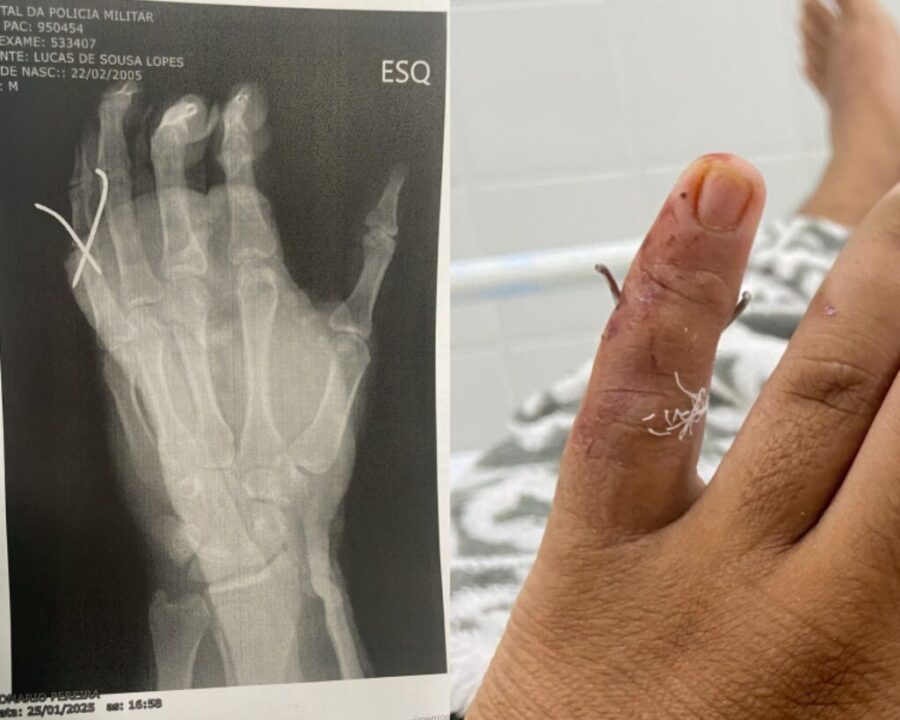 Família denuncia que jovem passou por cirurgia em dedo errado; HPM apura o caso