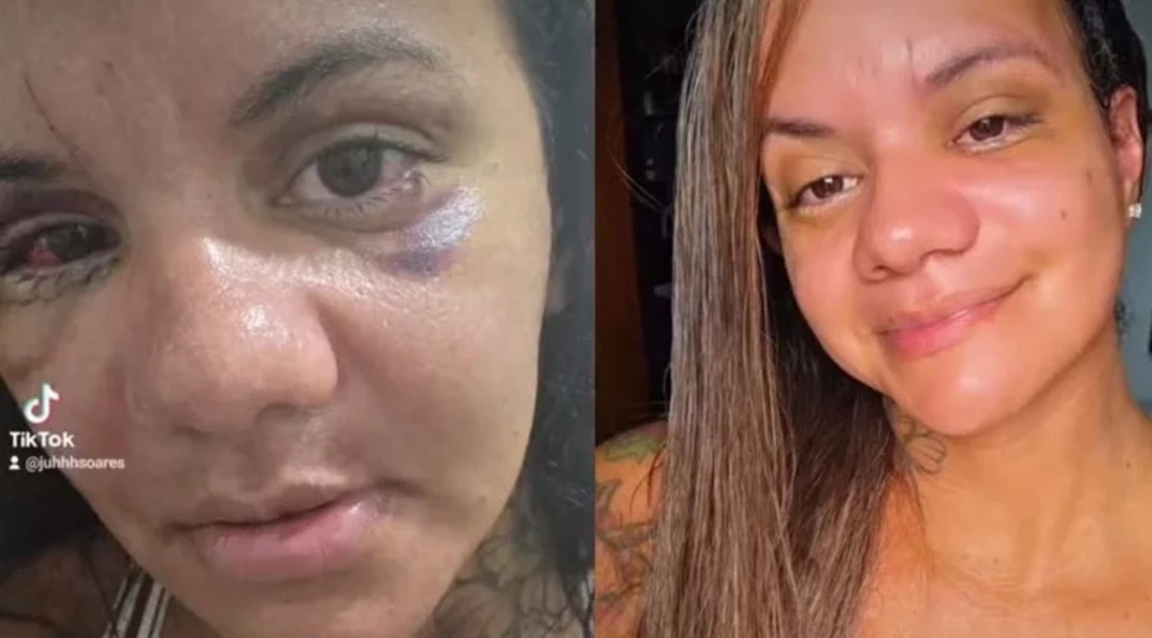 Um mês após cirurgia, mulher espancada com 61 socos por ex-jogador mostra rosto reconstruído